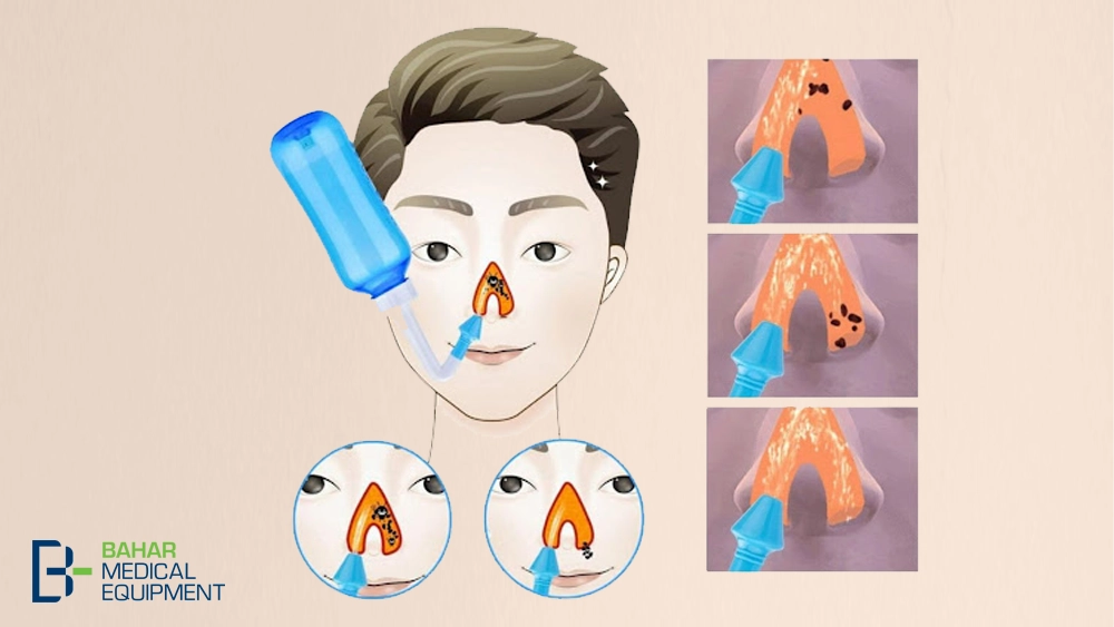 شستشوی سینوس ها